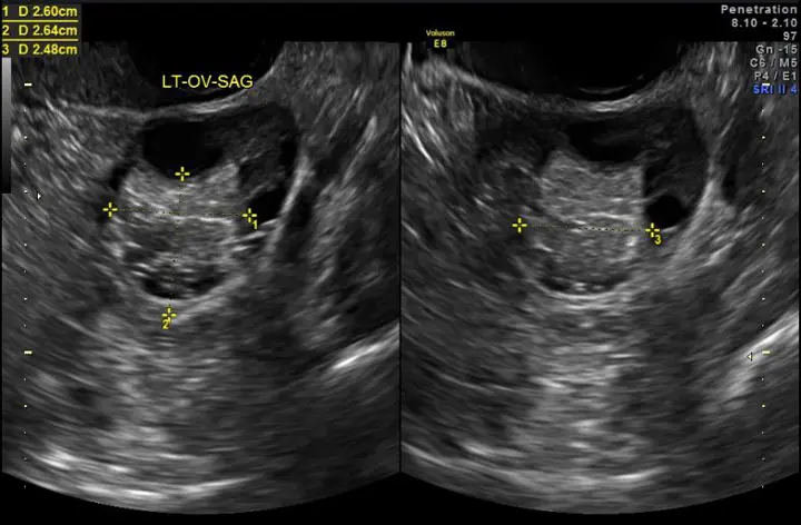 chocolate cyst ultrasound - Are chocolate cysts serious