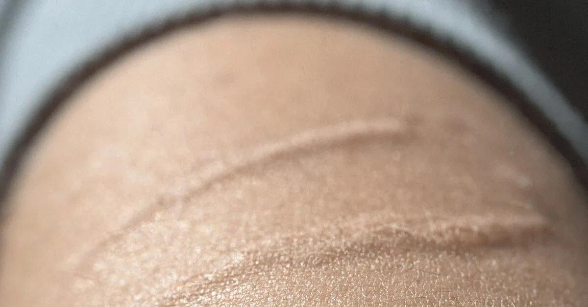 chocolate para cicatrices - Cómo hacer una crema casera para cicatrices
