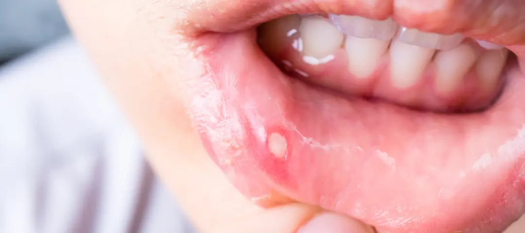 alergia al chocolate me hace salir llagas - Cómo se manifiesta la alergia en la boca