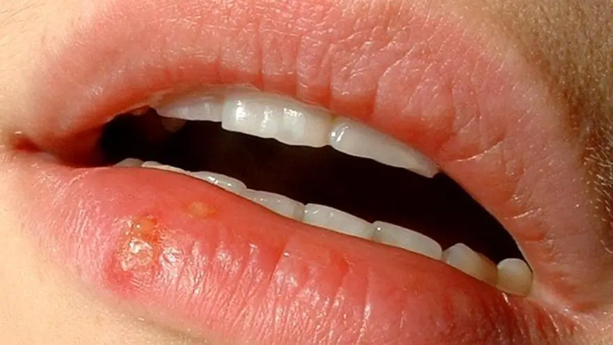 alergia al chocolate me hace salir llagas - Cómo se manifiesta la alergia en la garganta