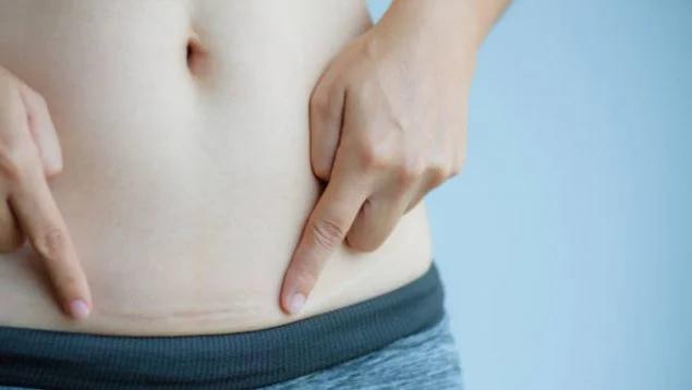 puedo comer chocolate despues de una cesarea - Cuándo ya puedo comer de todo después de una cesárea