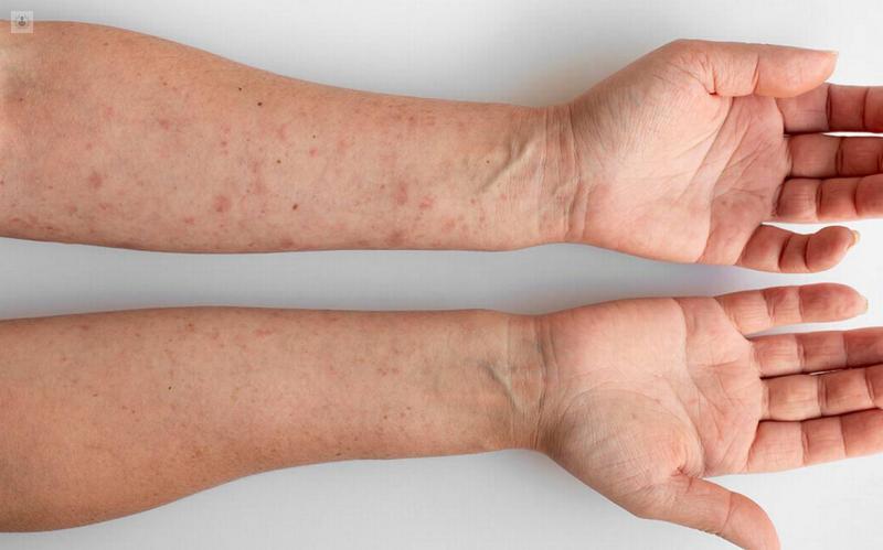 alergia chocolate urticaria - Cuánto dura la urticaria por alimentos
