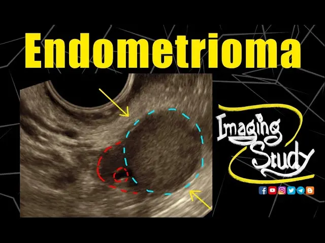 chocolate cyst ultrasound - Do chocolate cysts show on ultrasound