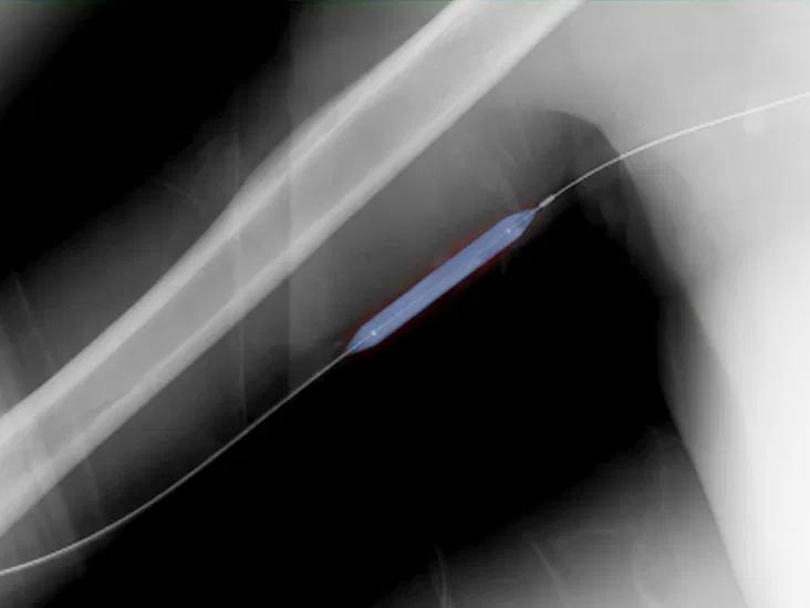 chocolate balloon angioplasty - How successful is balloon angioplasty