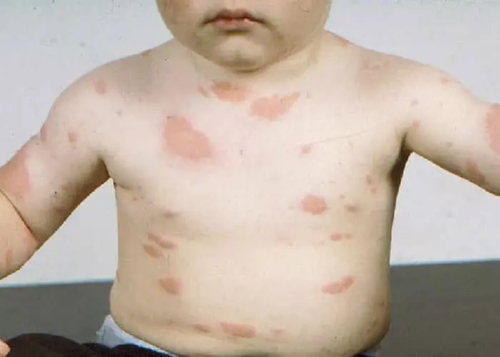 urticaria chocolate - Qué agrava la urticaria