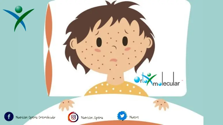 Se puede comer chocolate con varicela: La verdad sobre la dieta y la varicela - Qué alimentos evitar en caso de varicela se puede comer chocolate con varicela - Qué alimentos evitar en caso de varicela