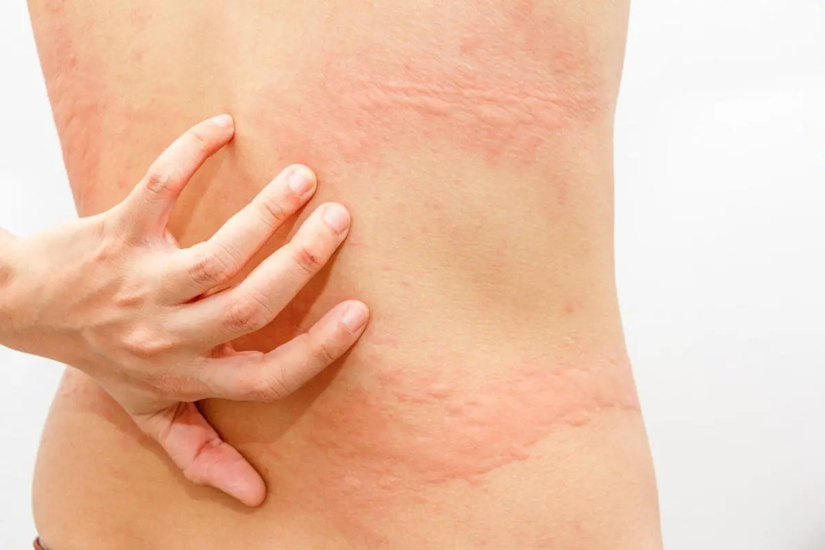 urticaria chocolate - Qué alimentos pueden causar urticaria