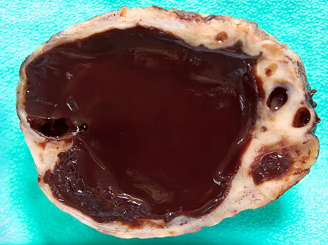 tumor chocolate ovario - Qué es un tumor endometrioma